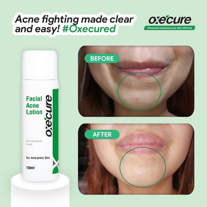 Oxecure Facial Acne Lotion (10ml)