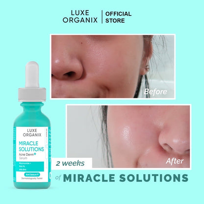 Luxe Organix Miracle Solutions AHA/BHA Acne Derm+ Serum (30ml)