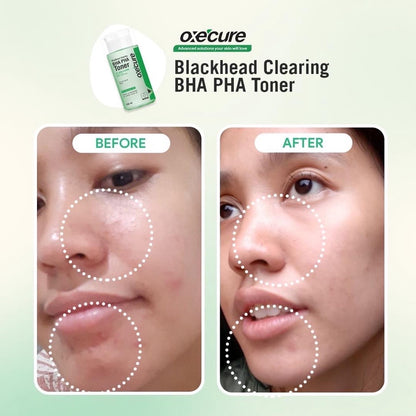 Oxecure Blackhead Clearing BHA PHA Toner (150ml)